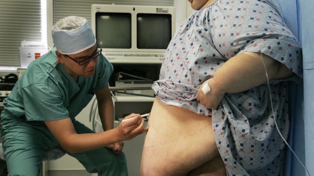 Does california medi-cal cover weight loss surgery